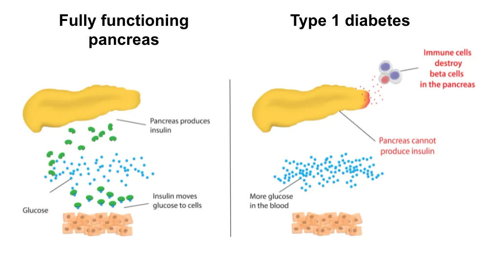 3242 honeymoon diabetes fatigue